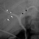 Triple Confluence Type Operative Cholangiogram Demonstrates