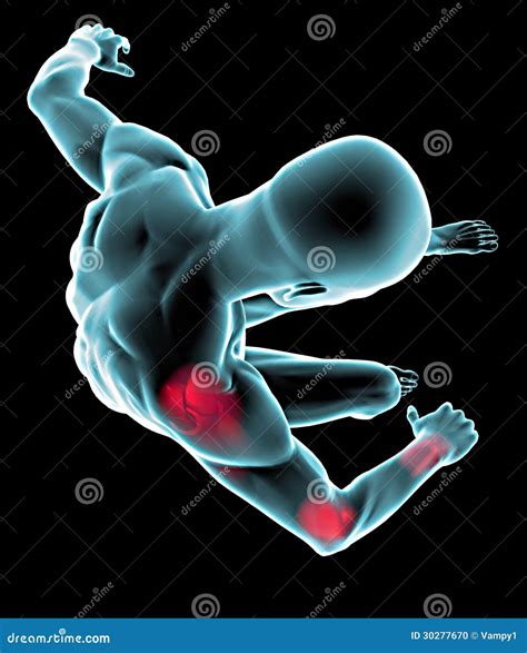 Dislocation Of The Elbow Joint. Stock Image | CartoonDealer.com #210142885