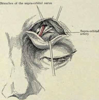 Supraorbital Nerve Anatomy Dr Barry Eppley Indianapolis - Explore ...