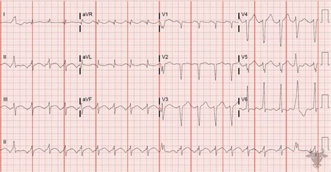 Atrial Tachycardia Ecg Stampede