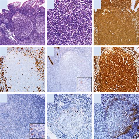 Pathological Features Of CD10 Downexpressed Gastrointestinal Follicular