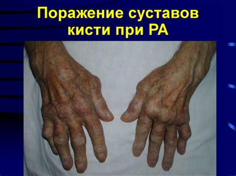 Ревматоидный артрит - презентация онлайн