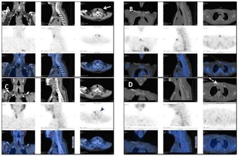 M Tc Tc Mibi Hybrid Spect Ct From Thoraco Mediastinal Region A