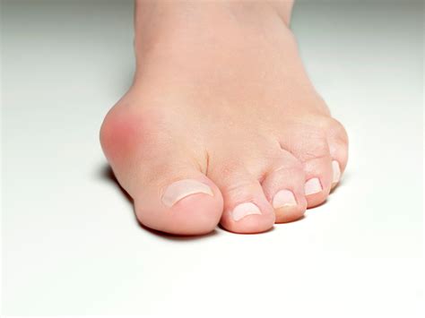 BUNION 拇趾外翻 Physio Sole Clinic