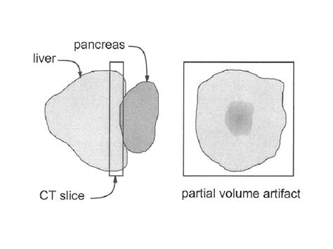 Computed Tomography Iii Reconstruction Image Quality Artifacts Simple