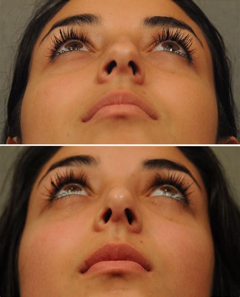 Dr. Franklin Alvear | Abierta vs cerrada, ¿Qué tipo de rinoplastia es