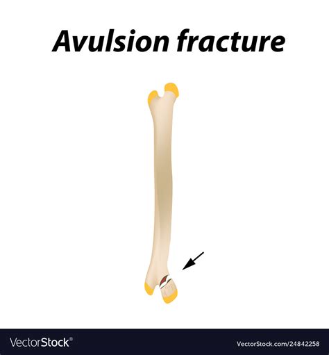 avulsion fracture bone infographics royalty  vector