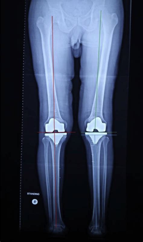 Sample Of Long Leg Standing Radiographic Image Of The Patient With