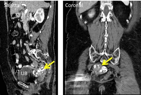 Calcified Uterine Fibroid Radiology Cases