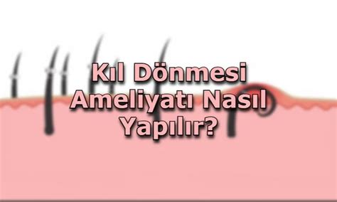 Anal Fist L Tedavisi Atak Y Cerrahi