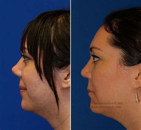 PHOTOS: Upturned Nose Rhinoplasty Case Study | Seattle Facial Plastic ... 