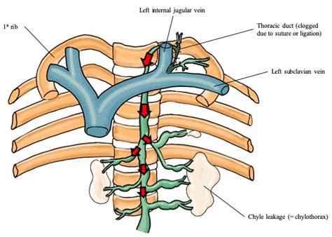 Medicina | Free Full-Text | Postoperative Chylothorax after Modified
