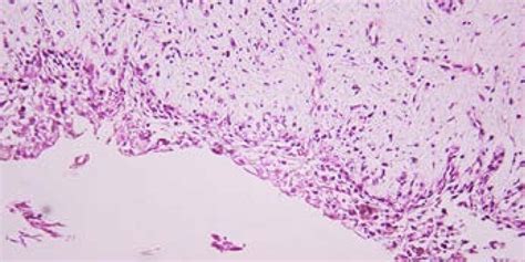 Photomicrograph Of The Lesion Showing The Odontogenic Epithelial Lining