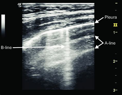 Image of A-lines and B-lines on lung ultrasound. A-lines are horizontal ...