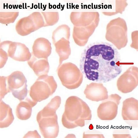 Howell Jolly Bodies In Neutrophils Blood Academy