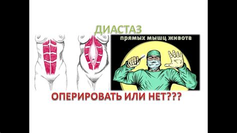 Диастаз прямых мышц живота: нужно ли оперировать? Виды операций. - YouTube