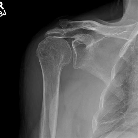 Dr Mcclintocks Shoulder X Ray Image Gallery Kyle Mcclintock Do