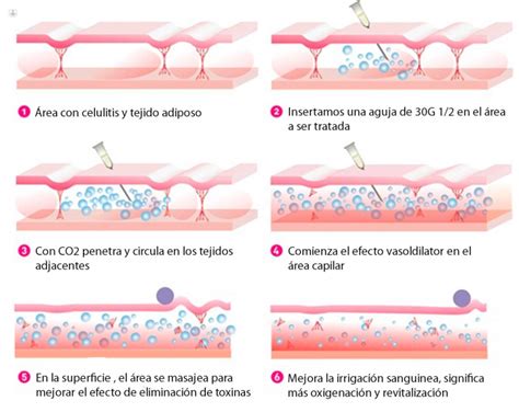 Carboxiterapia Para Tratar Celulitis Y Exceso De Grasa Top Doctors