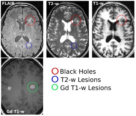 Ms Brain Mri With Contrast