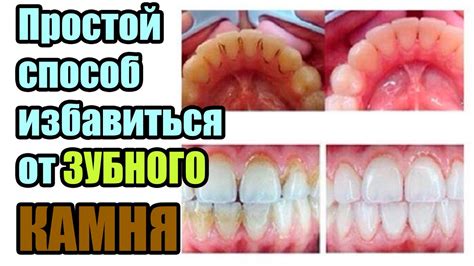 Как избавиться от зубного камня в домашних условиях - YouTube