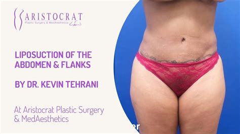 Liposuction Of The Abdomen And Flanks Long Island New York By Dr Kevin Tehrani Youtube