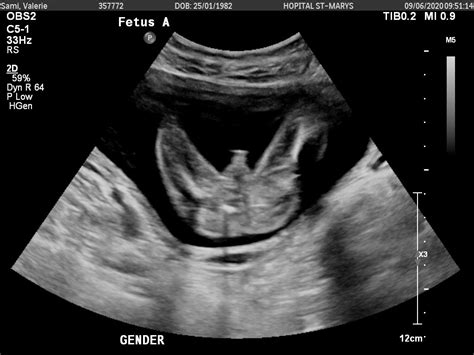 25 Weeks Pregnant Ultrasound Girl