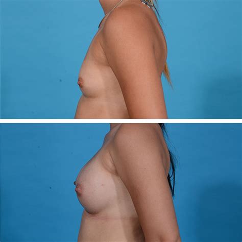 Breast Augmentation Gallery Dr Jeffrey Lisiecki