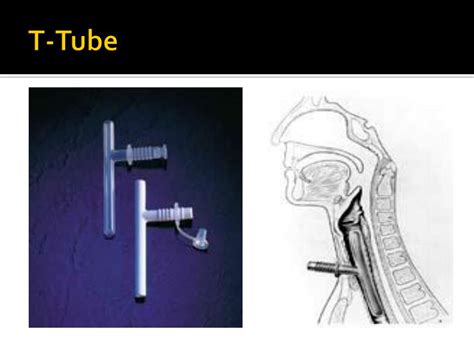 Ppt Open Reconstruction Of Airway Stenosis Powerpoint Presentation