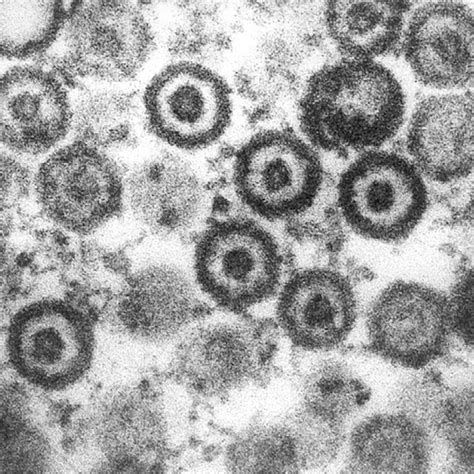 hsv   hsv  diseases   localization