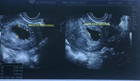 O Que É Um Saco Gestacional - 8 semanas e só visualizei o saco gestacional | BabyCenter