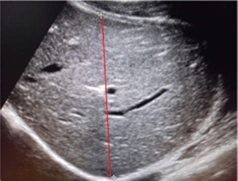 Enlarged Liver Ultrasound