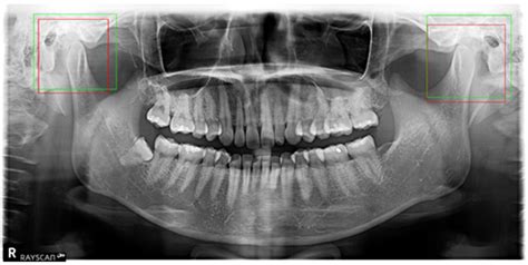 Applied Sciences | Free Full-Text | Expert System for Mandibular Condyle Detection and ...