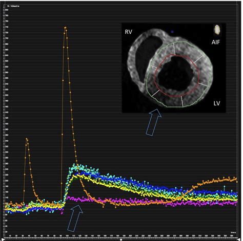 Myocardial First Pass Dual Bolus Perfusion Imaging Showing A Perfusion