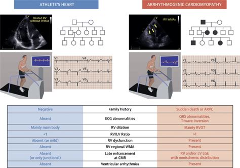 Differential Diagnosis Between Arrhythmogenic Cardiomyopathy And