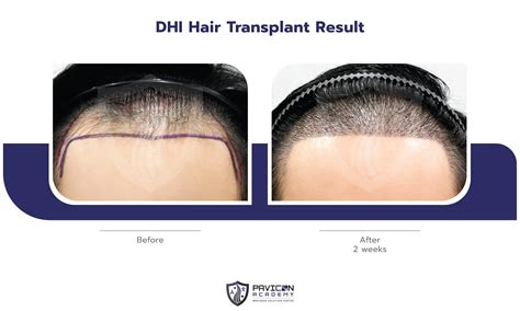 DHI Hair Transplant - Pavicon Mediness Center