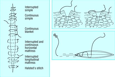 traumatic  surgical wounds  bmj