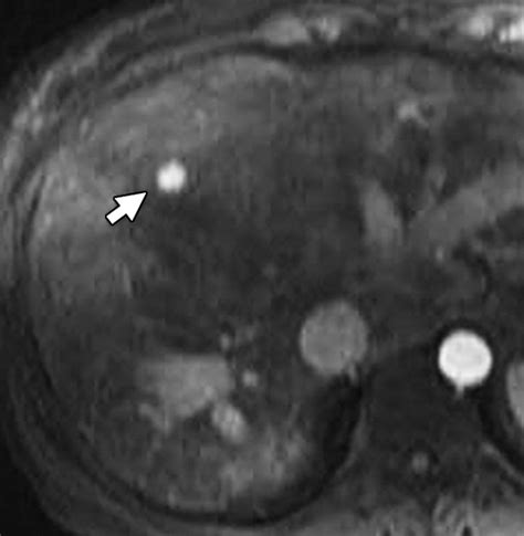 Imaging Findings Of Congestive Hepatopathy Radiographics