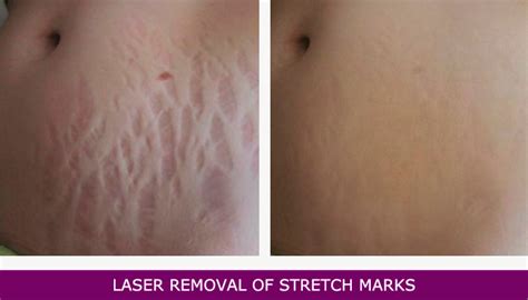 Laser Treatment To Remove Stretch Marks