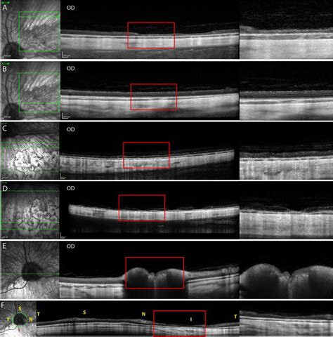 Optical Coherence Tomography Oct Images Of A Peripheral Superonasal