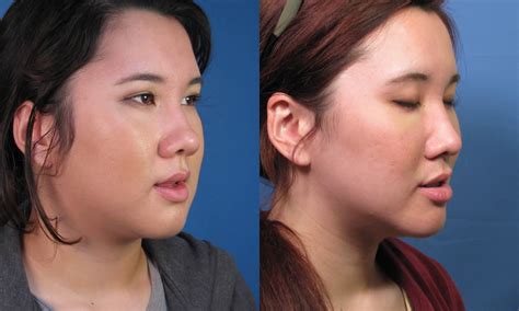 Asian Rhinoplasty Nose Job Surgery By Expert Ethnic Nose Surgeon Dr