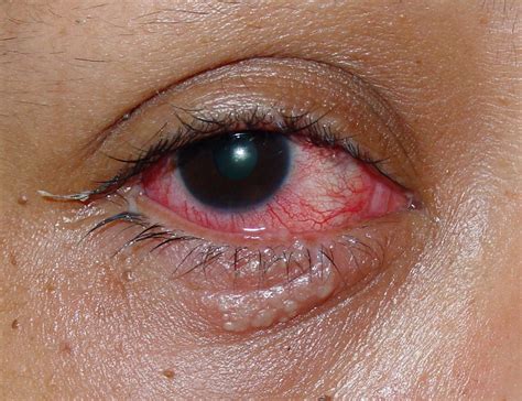 Blefaritis Herp Tica Y Conjuntivitis Atlas De Oftalmolog A