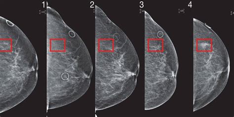 Breast Cancer Mammogram