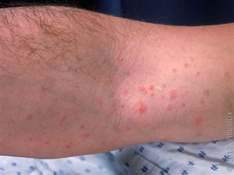 Scabies On Arms