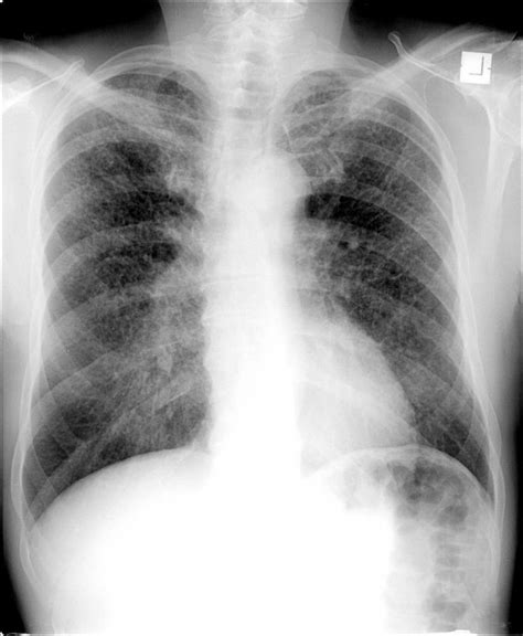 Erdheim Chester Disease With Skeletal And Lung Involvement Radiology