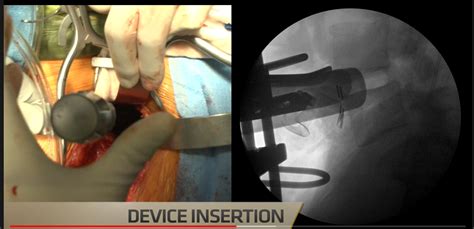 Centinel Spine For Prodisc® Motion Preservationdisc Arthroplasty And