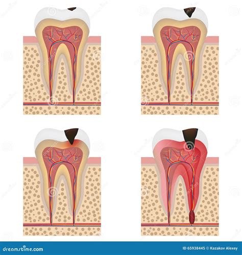 Dental Term Caries at Andrea Kirkham blog