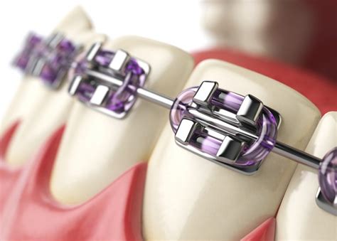 What Do Spacers For Teeth Do