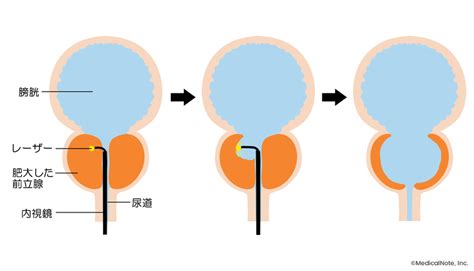 前立腺肥大症の低侵襲治療“レーザー前立腺蒸散術”とは メディカルノート