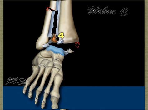 syndesmotic injury mechanism and treatment subject review