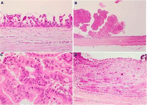 A High Grade Epithelial Dysplasia With Micropapillary Features